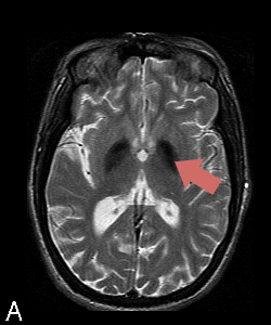 MRI-BPANa-3