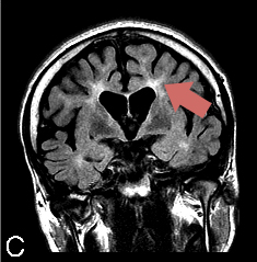MRI-FAHNc-3