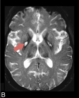 MRI-NFTb-3